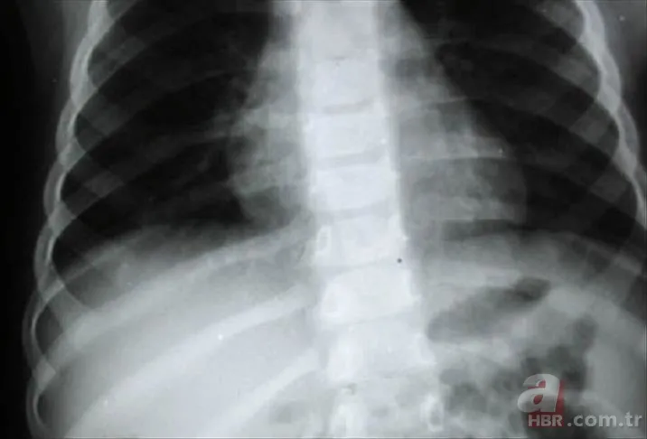 Eğer sabahları bunu yaşıyorsanız doktora gidin! Akciğer kanserinin ilk belirtisi uyandığınızda ortaya çıkıyor! Uzmanlar açıkladı 4