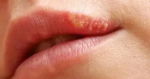 Uçuğu 1 günde yok eden formül! Akşamdan sabaha iyileştiriyor...