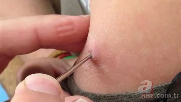 Genç kadının kolundan çıkanlar şoke etti 8