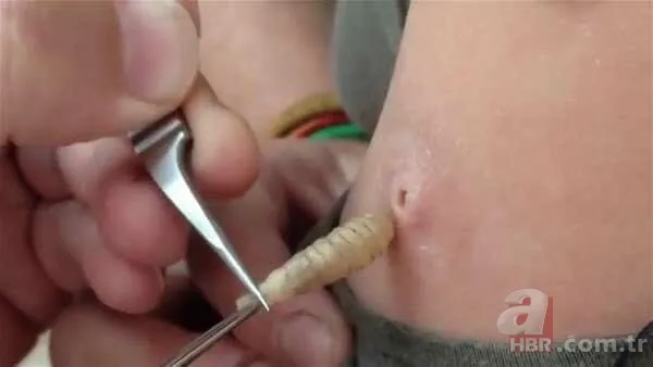 Genç kadının kolundan çıkanlar şoke etti 12