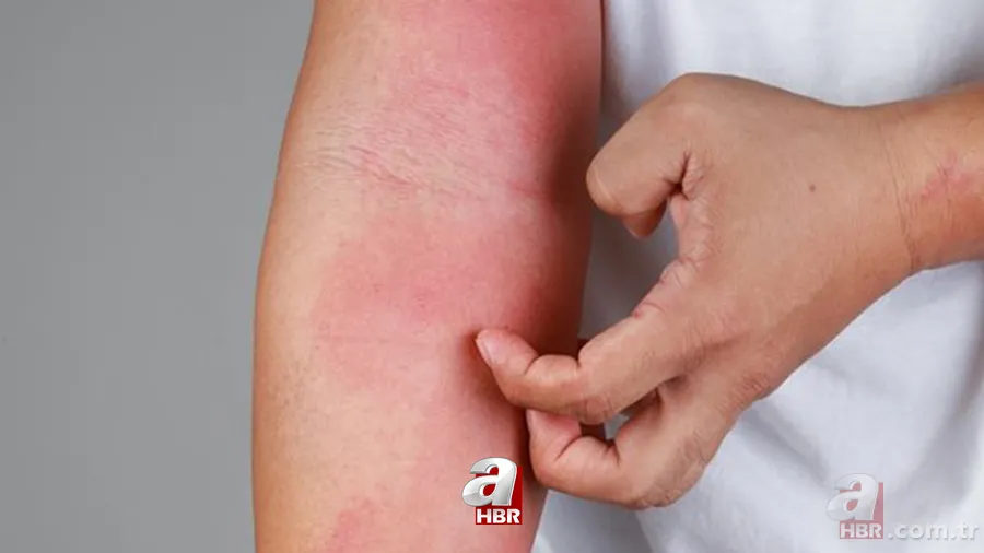 Kurdeşen dökmek ne demek? Kurdeşen (ürtiker) nedir, neden olur, sebepleri neler? Tedavisi var mı, ne iyi gelir? 1