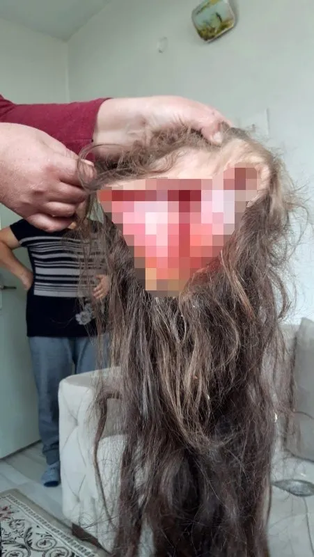 Dehşete düşüren olay! Tarlada çalışan genç kadının saç derisi koptu