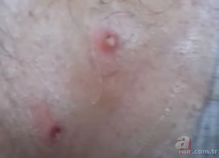 Sırtındaki yarayı sivilce zannetti ama gerçek dehşete düşürdü! Bakın içinden ne çıktı 16