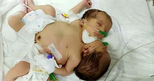 Afrinli yapışık ikizler Hatay’a getirildi