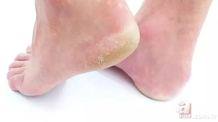 Ayak mantarını söküp atan yöntem! 10 dakikada pamuk gibi yapıyor 4