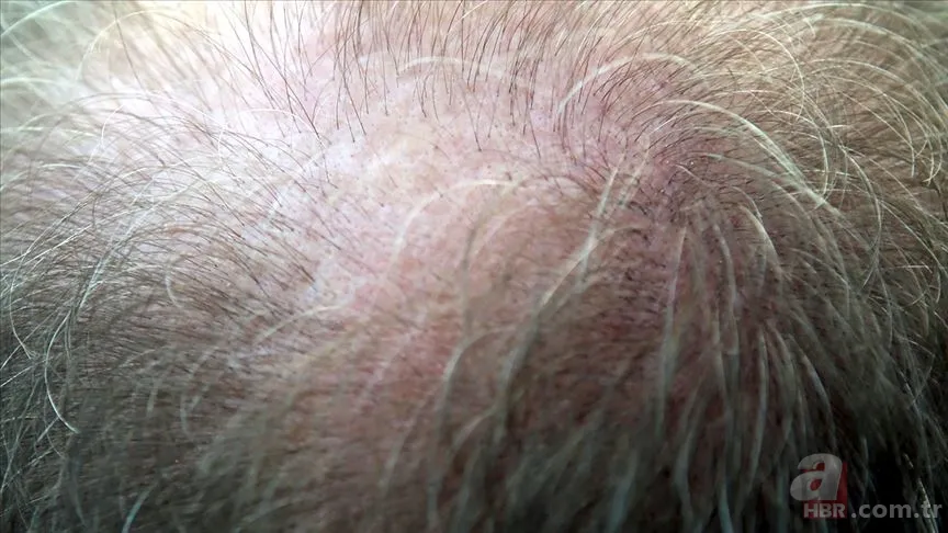 Saçınızın en büyük düşmanı! Köklerinizi nasıl öldürüyor? İşte bilimsel kanıtı 2