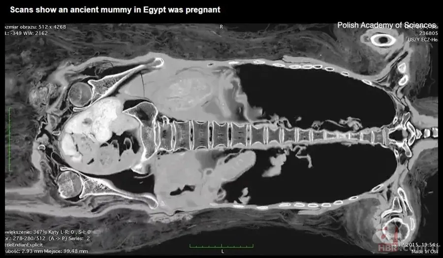 Doğmamış çocuğuyla mumyalandı: 2 bin yıl nasıl bozulmadan kaldı? "Gerçek bir insanlık trajedisi" 7