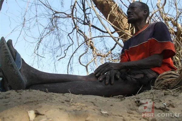 Dünyanın en tuhaf hastalıkları 25