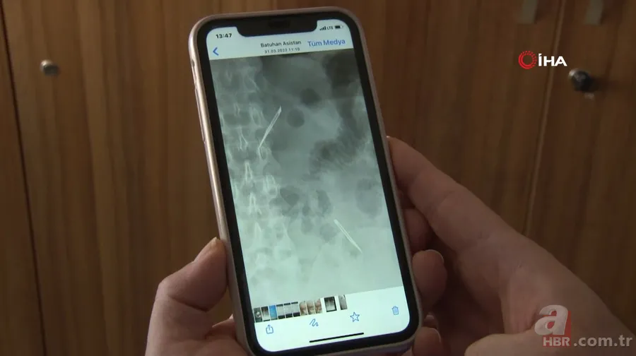 Amasya’da 22 yaşındaki genç kız karın ağrısı şikayetiyle hastaneye gitti! Gerçek şoke etti: Tam 5 kilo 13