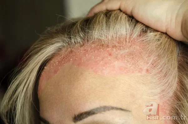 Egzamanızı tek 1 damlasıyla tarihe gömüyor! Saç kökünde kaşıntı, kepek, ağrı şikayetiniz varsa... 4