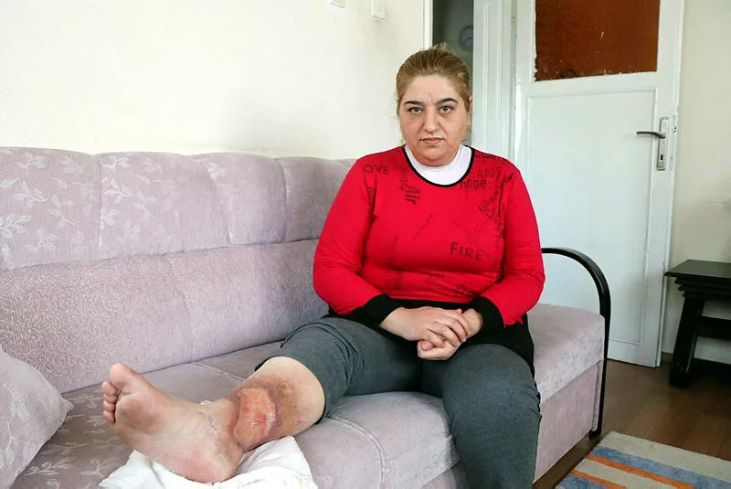 Sivilceyi önemsemedi, bacakları kesilecek duruma geldi