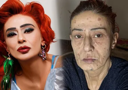 Saç boyası Yıldız Tilbe'nin yüzünü yakmıştı! Uzmanlardan uyarı geldi