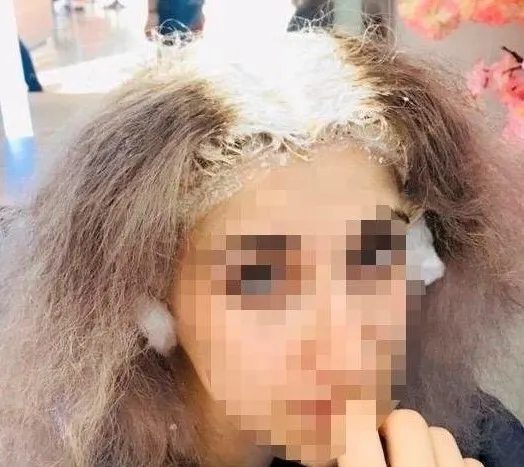 İstanbul’da saçını boyatmak isteyen kadının kafatası derisi yandı - 1