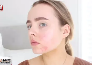 Maskeyle gelen yeni cilt hastalığı: Maskne