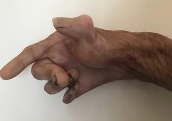 Sadece bir parmağı işlev görebilir halde