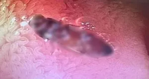 Hazımsızlık çekiyordu içinden canlı böcek çıktı!