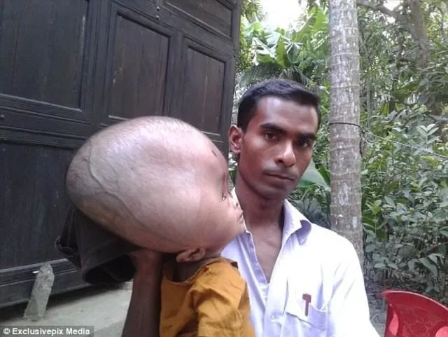 Bangladeşli Emon’un kafası süreli büyüyor
