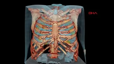 Korona akciğerleri bu hale getiriyor! İşte 3D görüntüsü