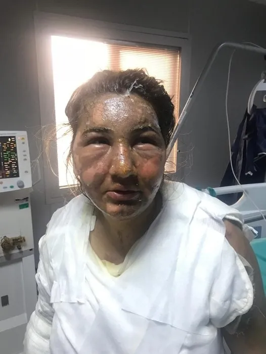 Sevgilisi kızgın yağ ile yakmıştı! 14 yıl ceza verilince "Bırakın onu" diye yalvardı - 2