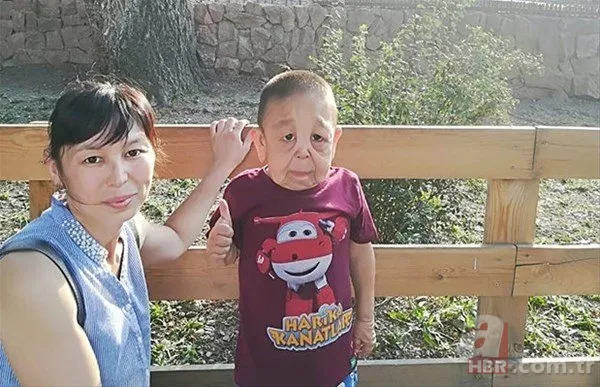 Dünyanın en tuhaf hastalıkları 4