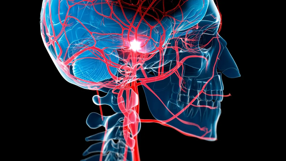 erken-yasta-inme-vakalari-neden-artiyor-kan-grubu-detayi-tip-dunyasini-sasirtti-1779611205369.jpg Neurology dergisinde yayımlanan araştırma, erken yaşta görülen inmelerin farklı mekanizmalarla ortaya çıkabileceğine işaret etti. (Fotoğraf: A Haber Foto Arşiv)