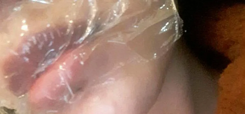 Eskişehir’de botoks yaptırıp hastanelik olan kadın: Çok kalabalıktı sanki koronalı botoks partisi vardı