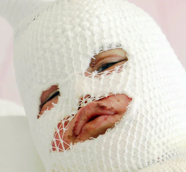 Kars’ta üstüne kaynar su dökülen 2 yaşındaki Hamit’in vücudu sargılarla kaplandı - 5