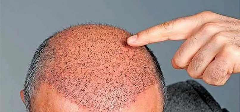 İstanbul saç ekim fiyatları ne kadar? En iyi saç ekim merkezi hangisi?