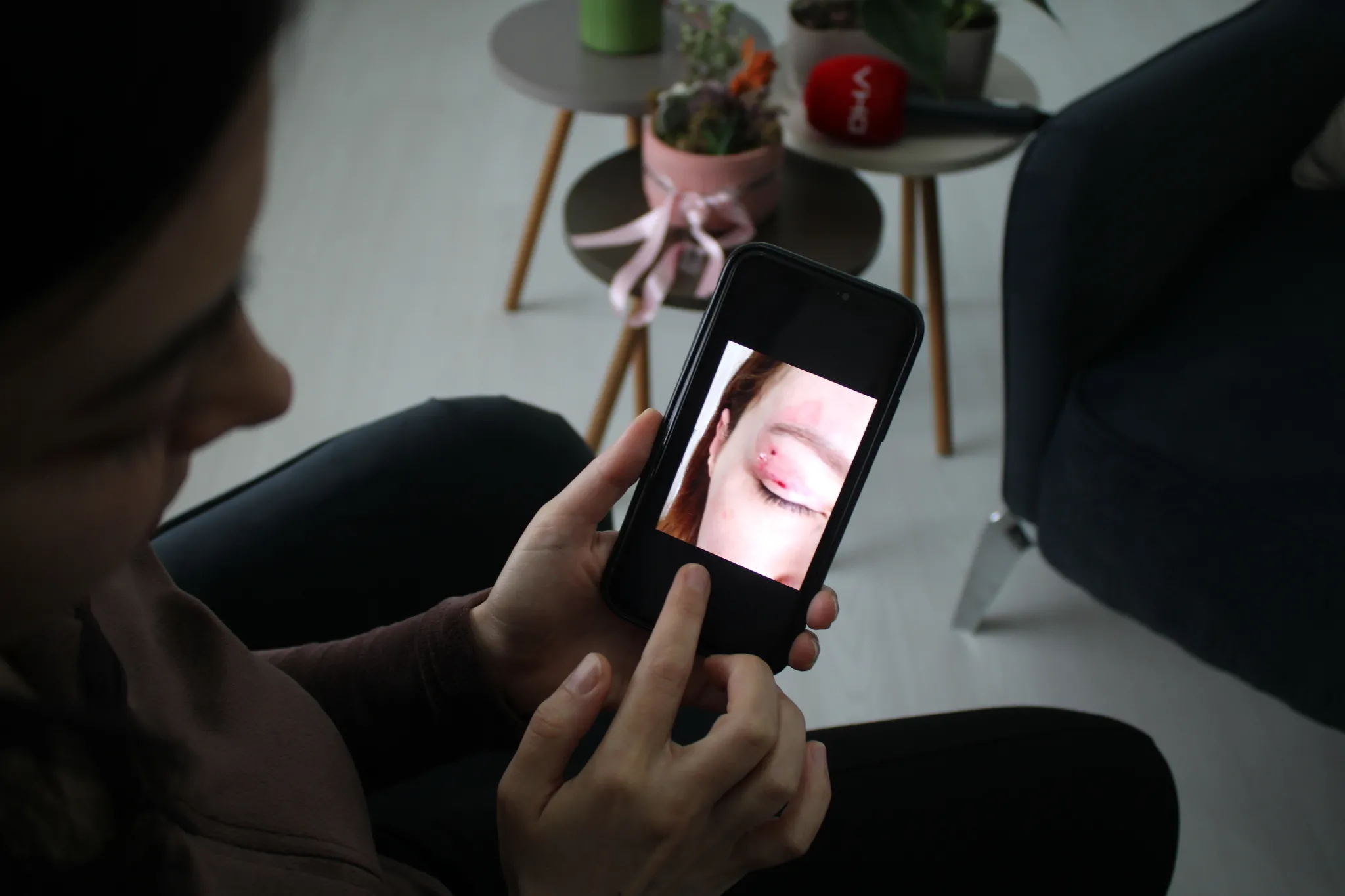 1100 TL’lik estetik kabusa dönüştü! Genç kız az kalsın gözünden oluyordu