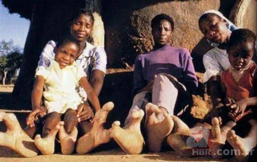 Dünyanın en tuhaf hastalıkları 19