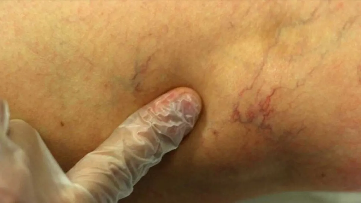 Yaz sıcakları varisleri tetikliyor