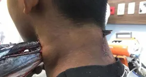 Denizden sıçrayan balık boynuna saplandı!