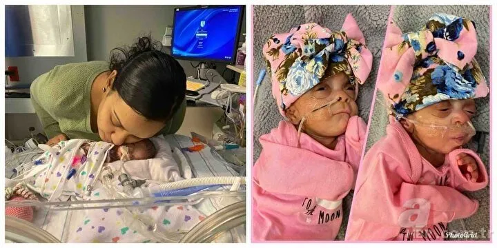 Doktorlar hiç şans vermemişti! Dünyanın en erken doğan ikizleri 1 yaşında! Guinness Rekorlar Kitabı’na girdiler
