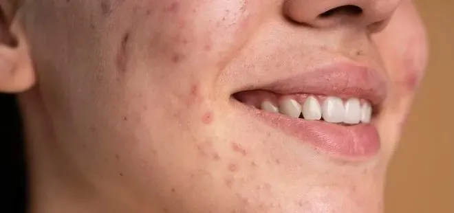 Yüzdeki sivilceler ne zaman tehlikeli bir hale gelir?