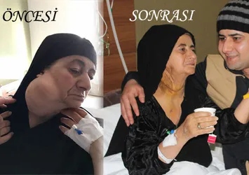 30 yıl boyunca boynunda 1 kilo tümör ile yaşadı