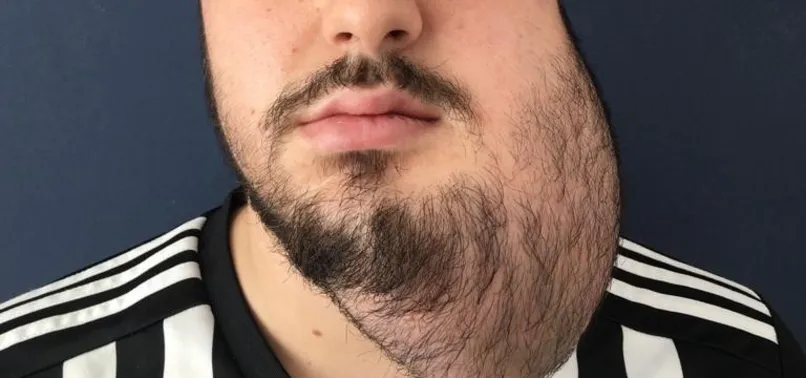 Aynalara küsmüştü! Yüzünün yarısı alınan Samet Öztürk'e bacağından yeni yüz yapıldı