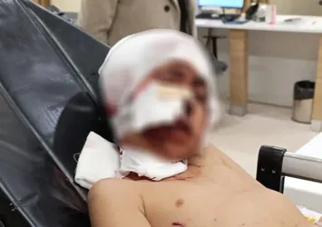 Erzurum'da sokak köpeği dehşeti! Bakan Tunç duyurdu: Soruşturma başlatıldı