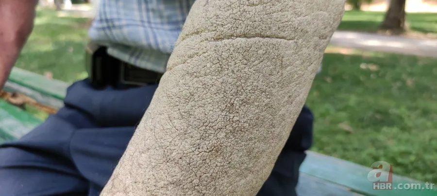 3 senedir gözlerini kapatamıyor! Sağlığına kavuşmak için Türkiye’ye geldi 15