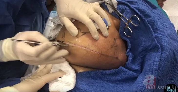 Sırtındaki dövmenin altında oluşan şişlik için doktora gitti 👩‍⚕️ Operasyonu gerçekleştiren doktor bile şaştı kaldı! Bakın sırtından ne çıktı