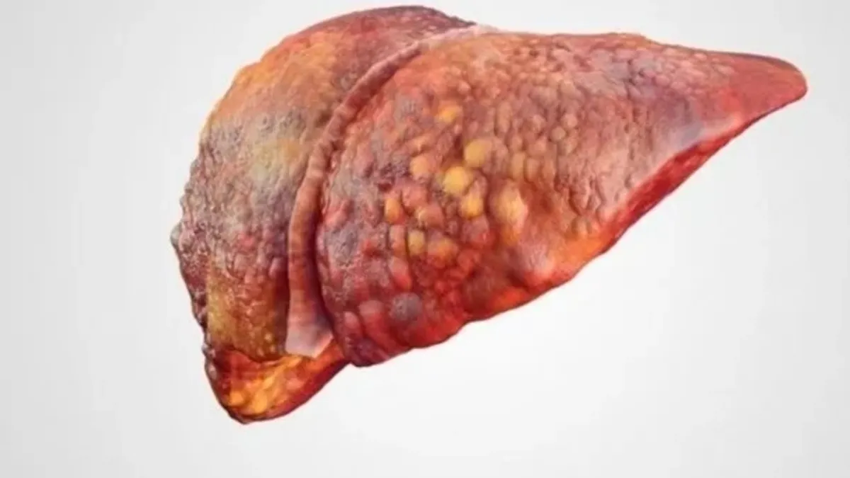Karaciğer yağlanması bu hastalıklara sebep oluyor
