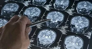 Alzheimer’ı yıllar önceden tespit edecek!