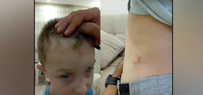 Karabük’te bir çocuk sokak köpeklerinin saldırısına uğradı