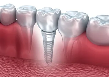 Titanyum implant kanser yapar mı?