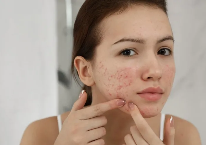 Sıcak havalarda artıyor! Akneyi önlemek için 10 öneri...