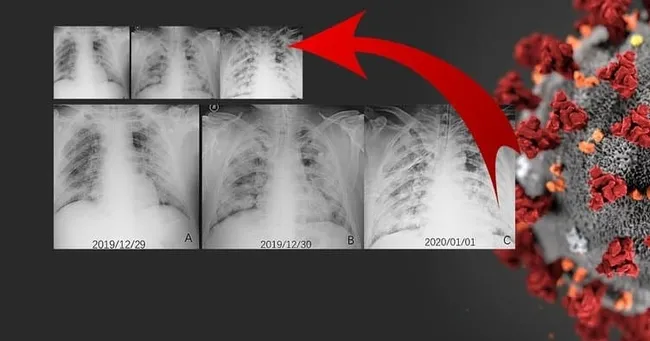 Koronavirüste büyük keşif: Hastalığı nasıl geçireceğimizi artık biliyoruz - 3