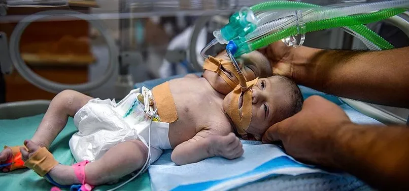 Gazze'de yapışık ikiz dünyaya geldi