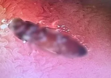 Hazımsızlık sebebiyle doktora gitti, içinden canlı böcek çıktı! Tıp dünyasını şaşırtan olay