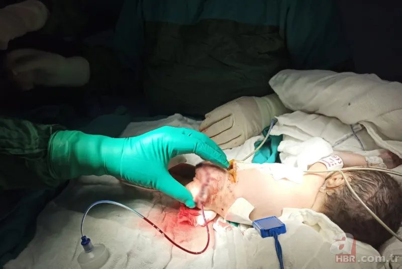 40 binde bir görülüyor! Kilosu kadar tümörle dünyaya geldi | Dünyanın en ilginç hastalıkları 5