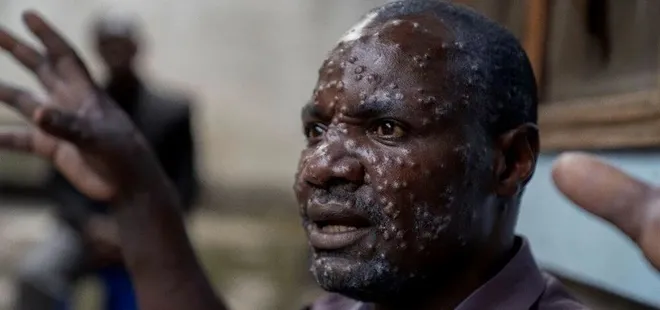 Afrika Birliği’nden M çiçeği salgını açıklaması: Afrika’nın değil tüm dünyanın sorunu