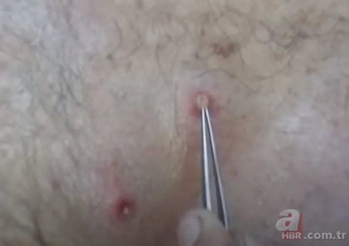 Sırtındaki yarayı sivilce zannetti ama gerçek dehşete düşürdü! Bakın içinden ne çıktı 24